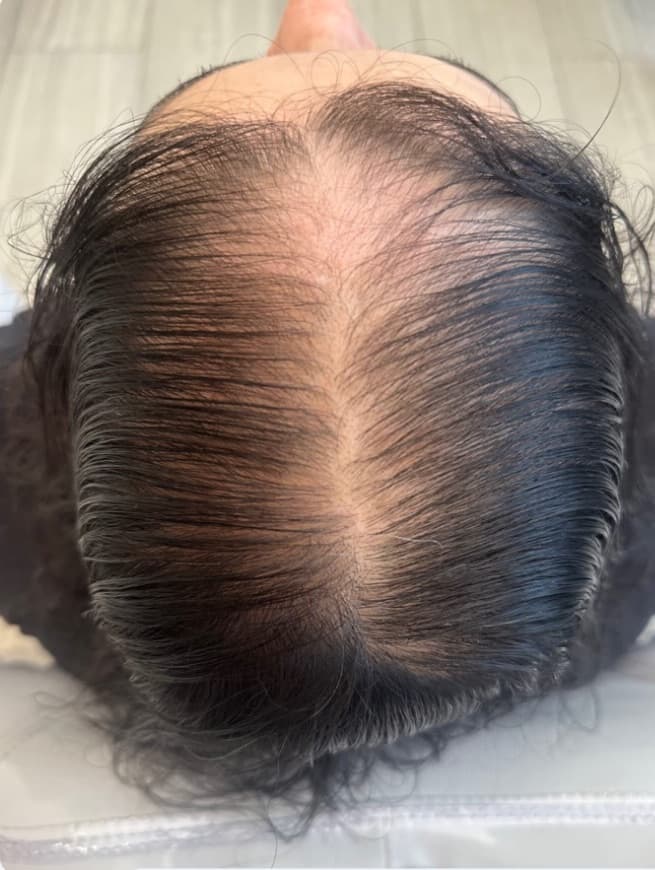 Alopecia androgénica — seguimiento — Antes