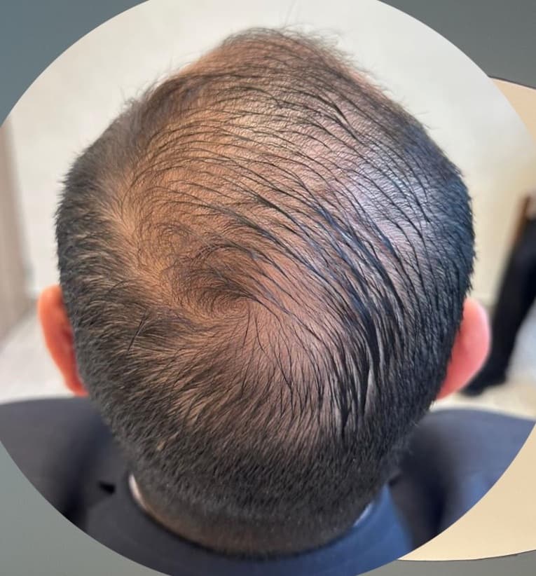 Alopecia areata — recuperación parcial — Antes